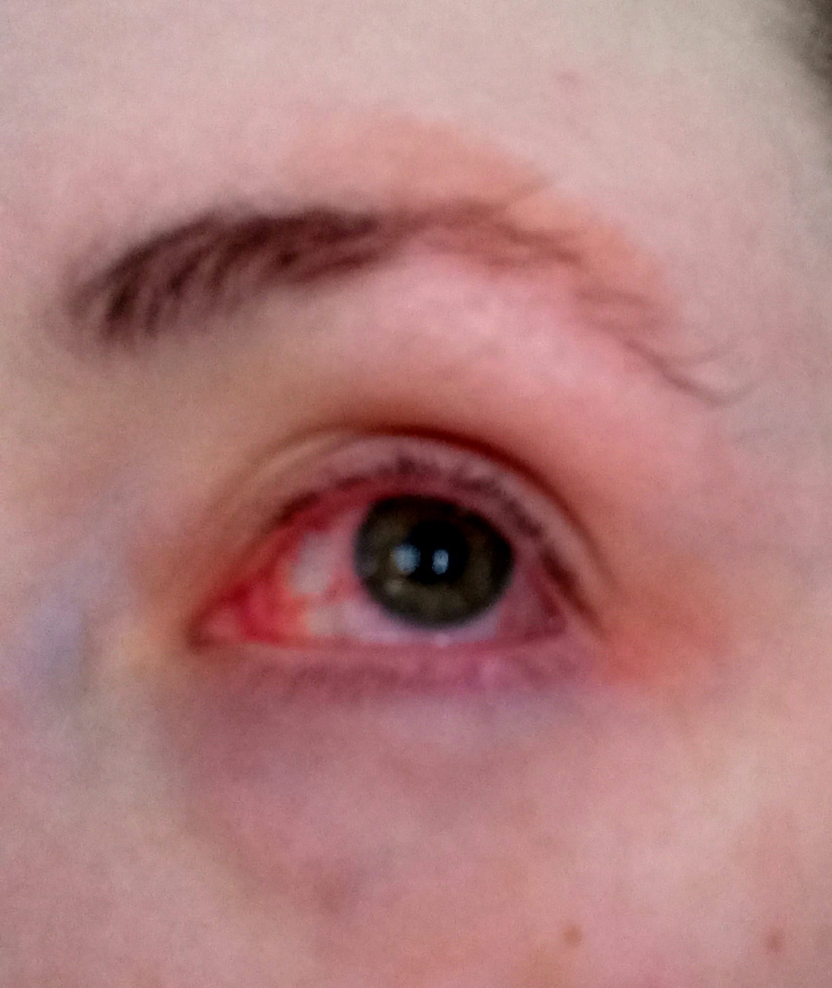 Winter-Crina DuBroc — Beginning of Eye Pterygium.