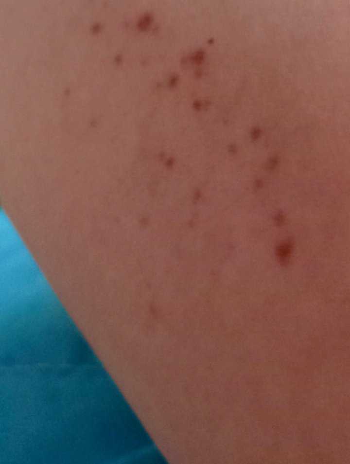 Katarïna DuBroc / OCD Vampire — Mild Porphyria Scabs