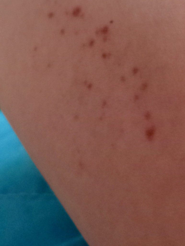 Winter DuBroc — Mild Porphyria Scabs