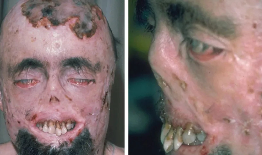Extreme Untreated Porphyria-Cutaneous