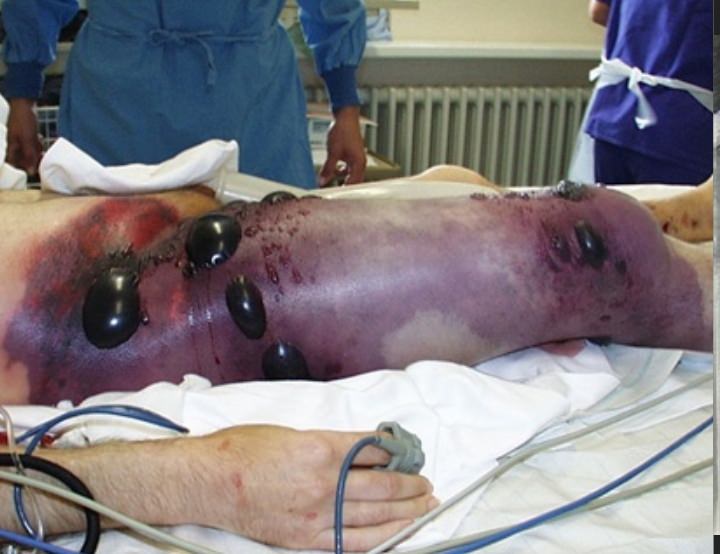 The Black Death Buboes — Modern Day